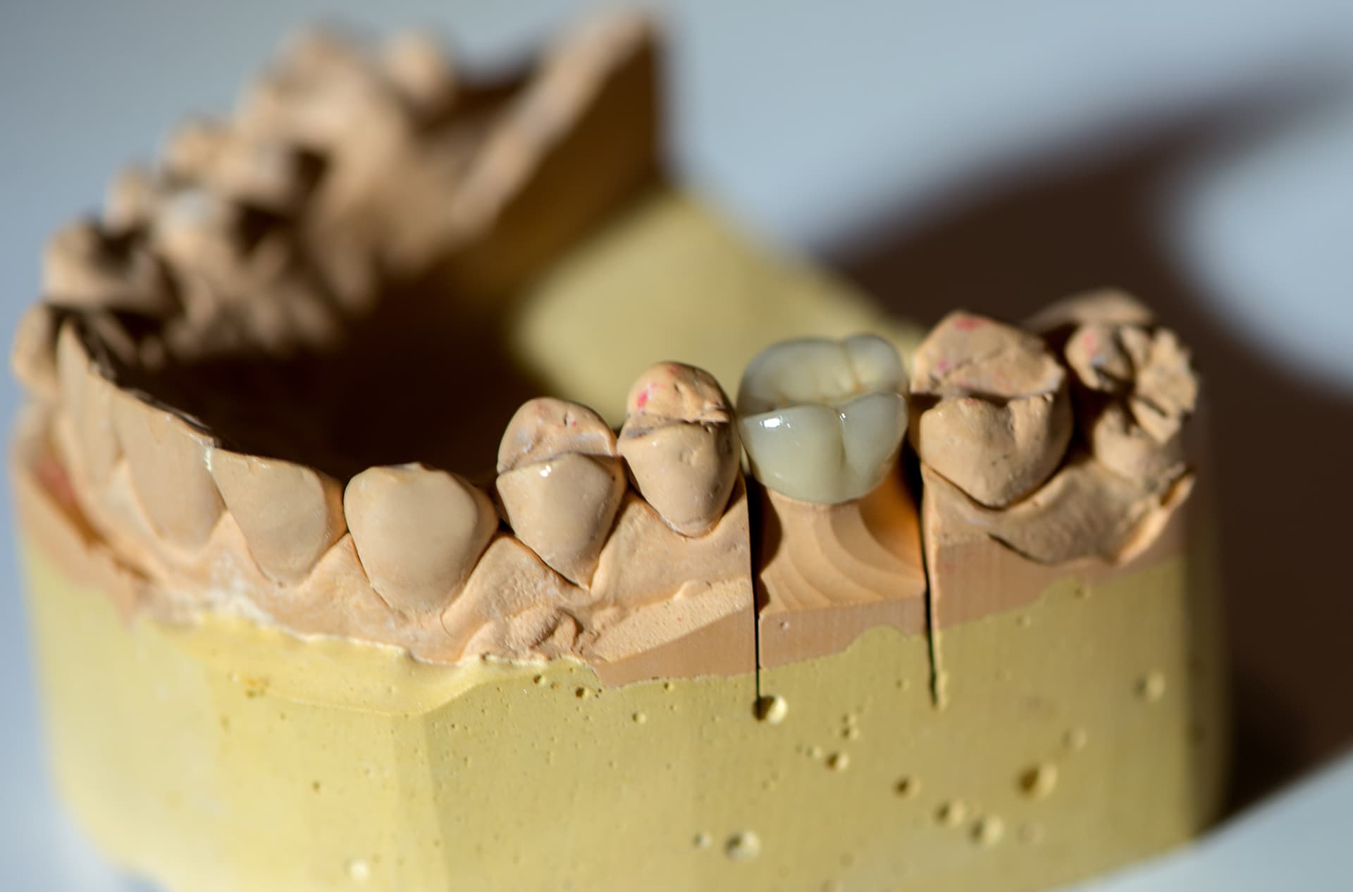 A Loose Dental Crown Before Travel: What Should You Do?
