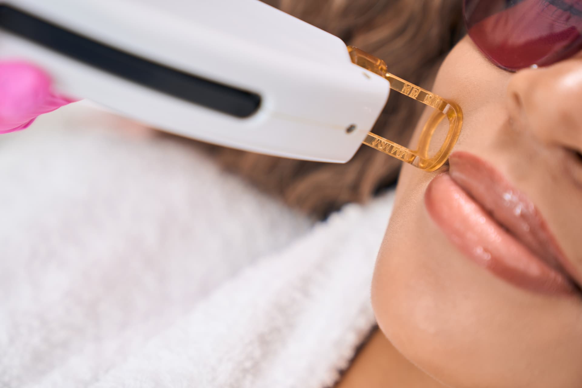 مريضة تتلقى إزالة الشعر بالليزر لمنطقة الشفة العليا